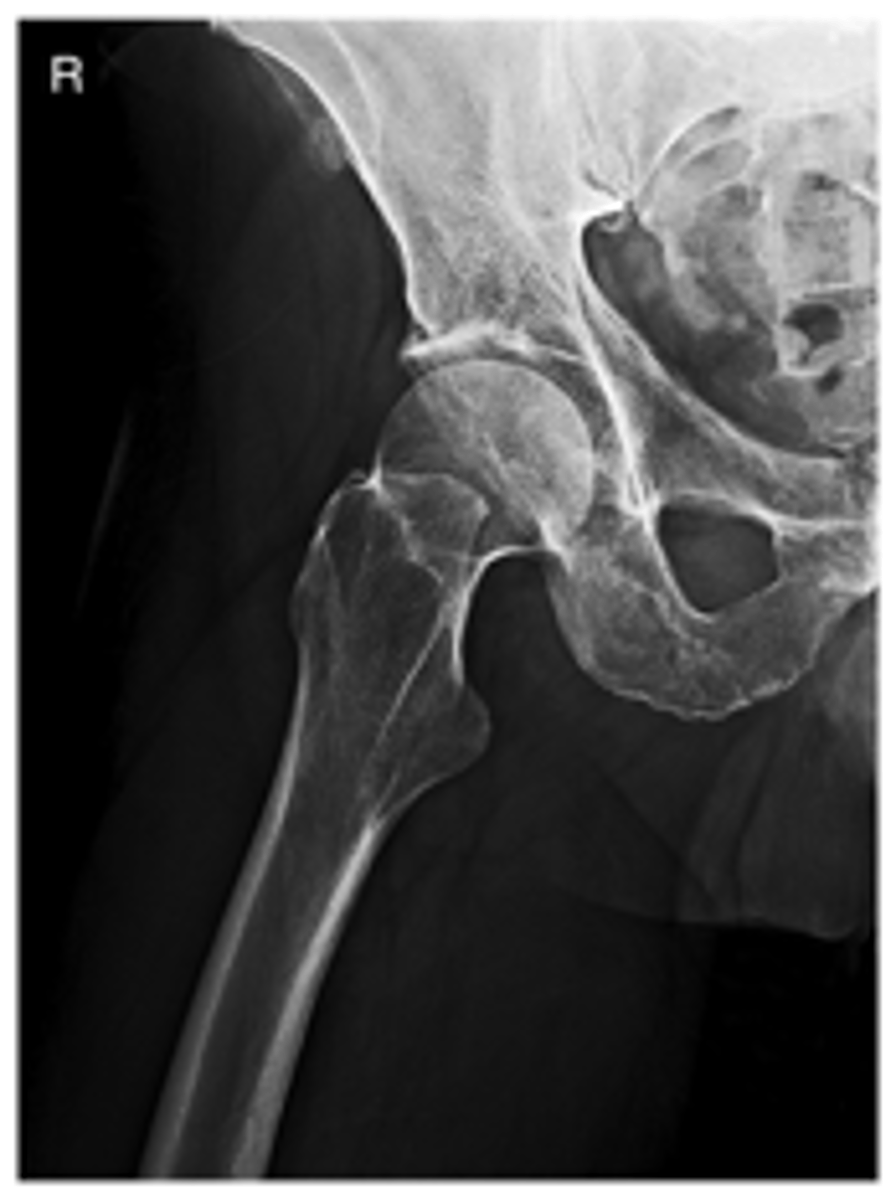 <p>- Abduct femur 45° from vertical (for best demonstration of femoral head and acetabulum, abduct femur to 90° from vertical)</p><p>- CR perpendicular to midfemoral neck</p><p>- Entire femoral head, neck, and trochanters centered to IR</p><p>- Femoral head and neck in profile</p><p>- 45° abduction (20° to 30° abduction—less distortion of femoral neck)</p>