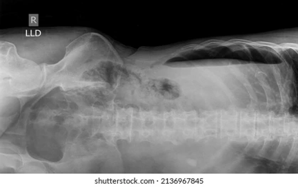 <p>Pneumoperitoneum</p>