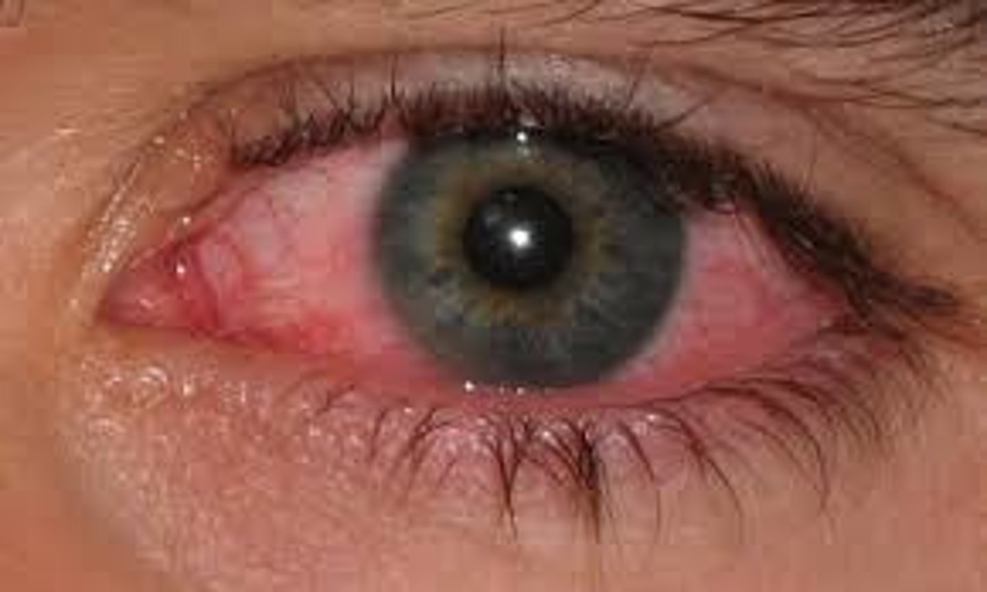 <p>Viral conjunctivitis</p>
