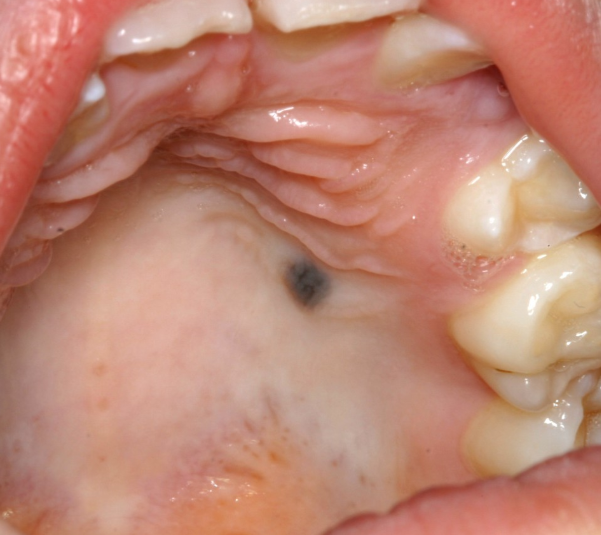 <p>9b. What would be a clinical feature of a benign brown pigmented lesion?</p>