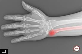 <p>process of ulna by the carpals&nbsp;</p>