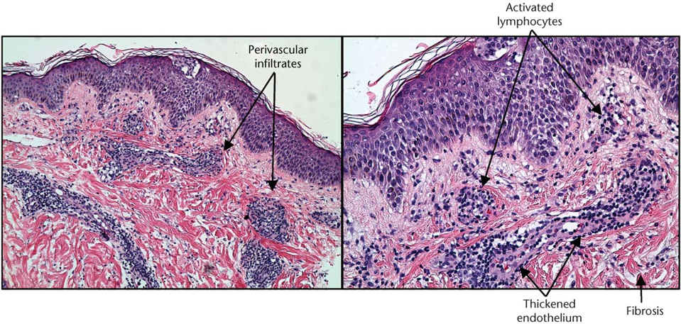 <p>TYPE 4 HYPERSENSITIVITY</p><p>causes epidermal necrosis and dermal inflammation by TH1 and potentially TH17 cytokines (think poison ivy)</p>