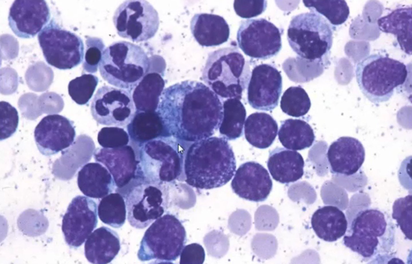 <p>Complication of acute leukemia; a severely elevated circulating immature WBC count --> blood is more viscous --> clot development</p>