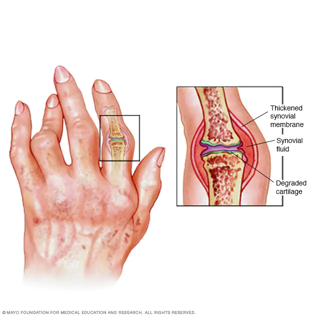 chronic joint condition where inflammation erodes joint tissue and deviates bone; caused by an autoimmune reaction. most common in middle aged women
