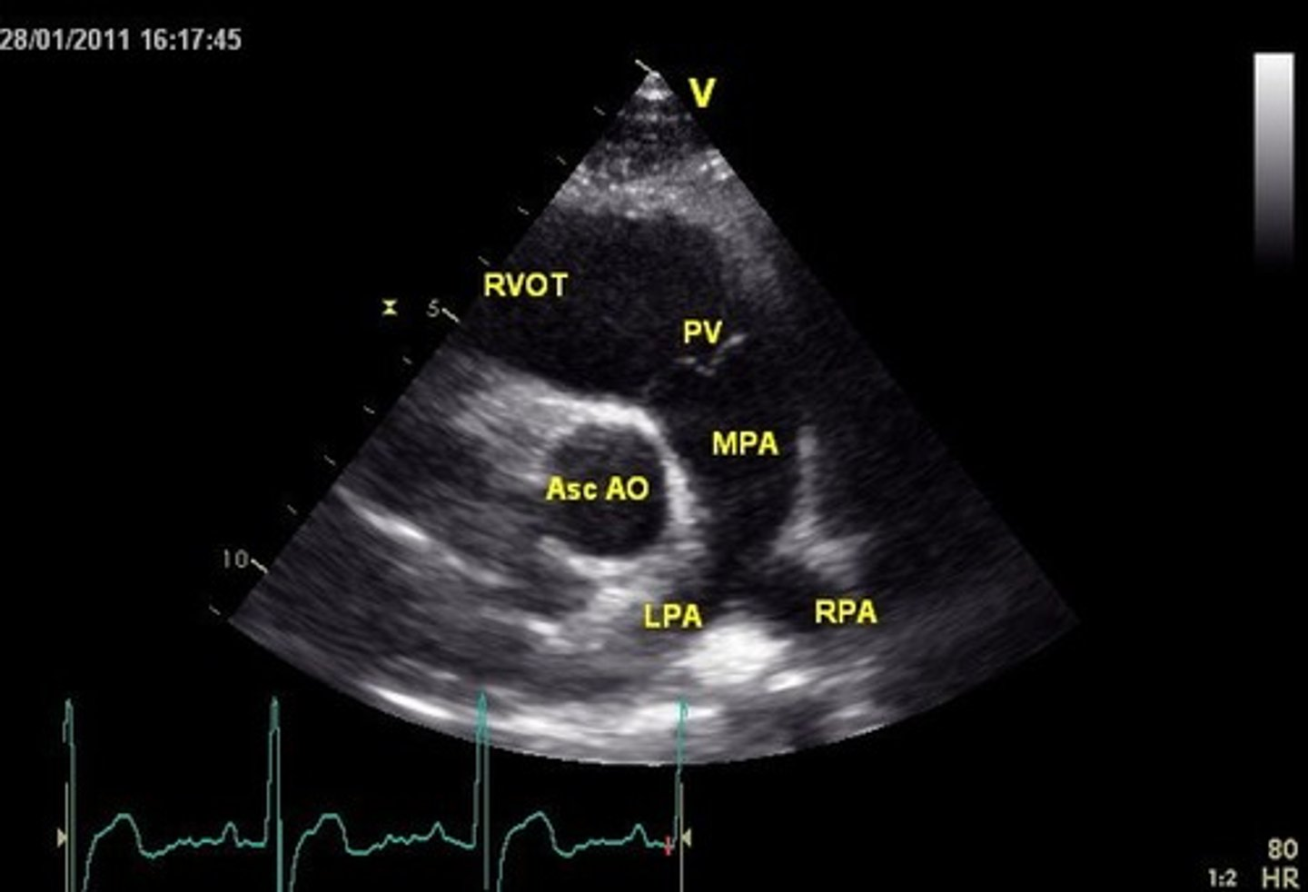 <p>RVOT is used to visualize _______</p>