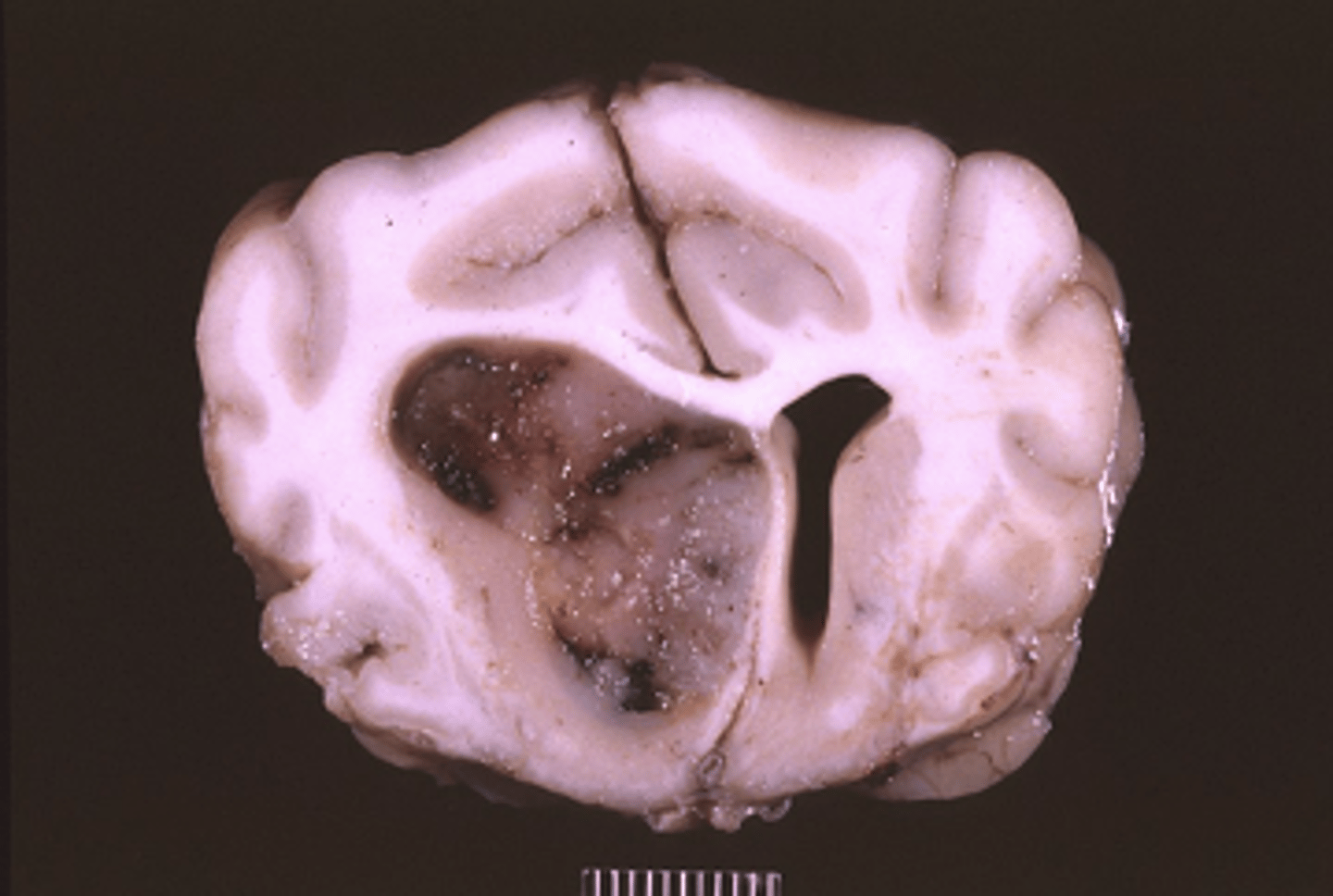 <p>Describe the margination of this lesion</p>