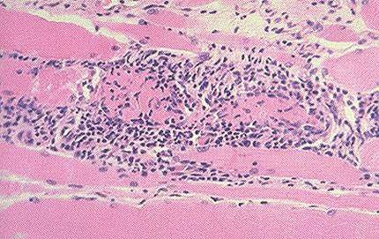 <p>(PM) is a muscle disease characterized by the simultaneous inflammation and weakening of voluntary muscles in many parts of the body. (poly- = many, myos = muscle, and -itis = inflammation).</p>
