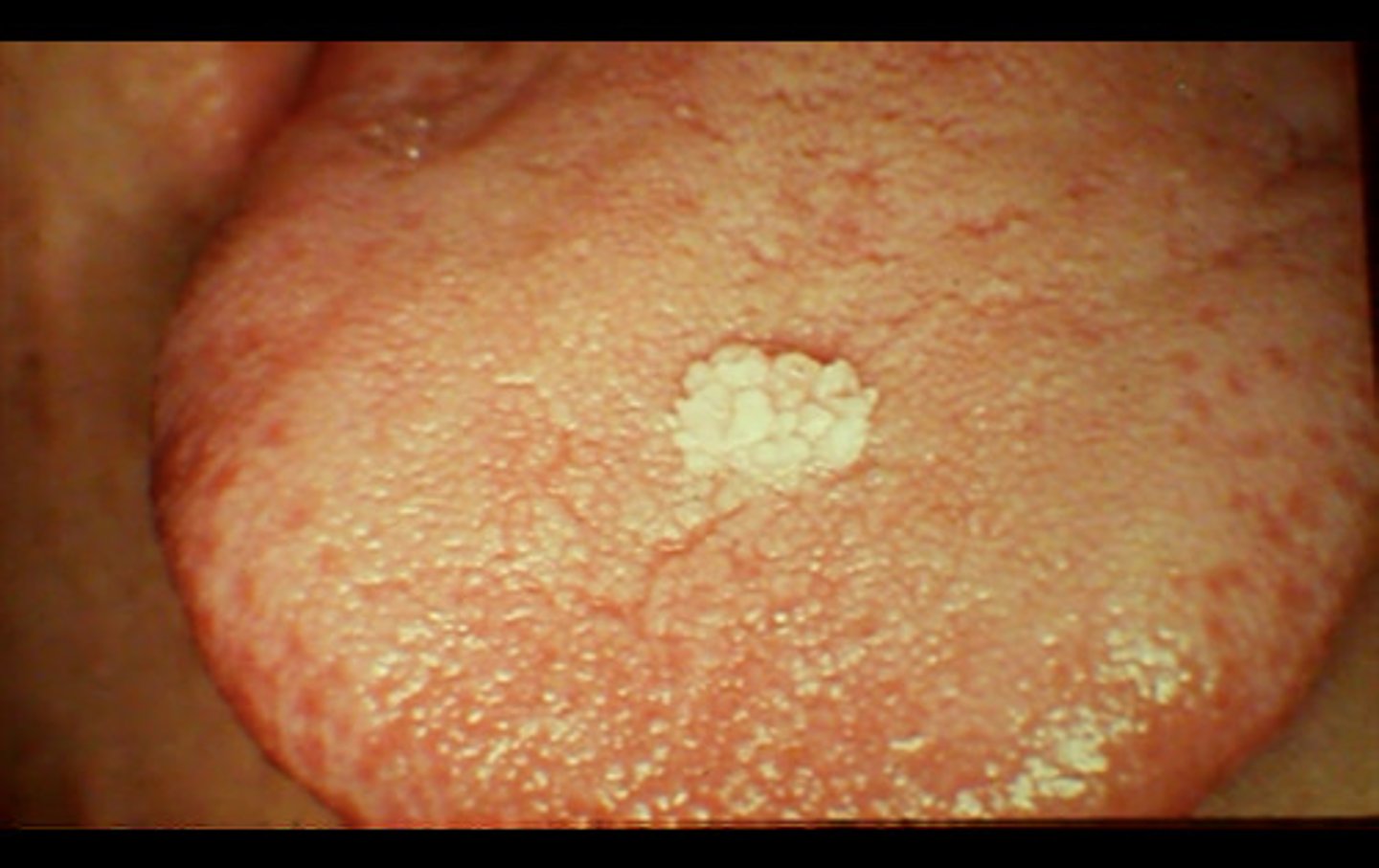 <p>Papilloma on a tongue</p>