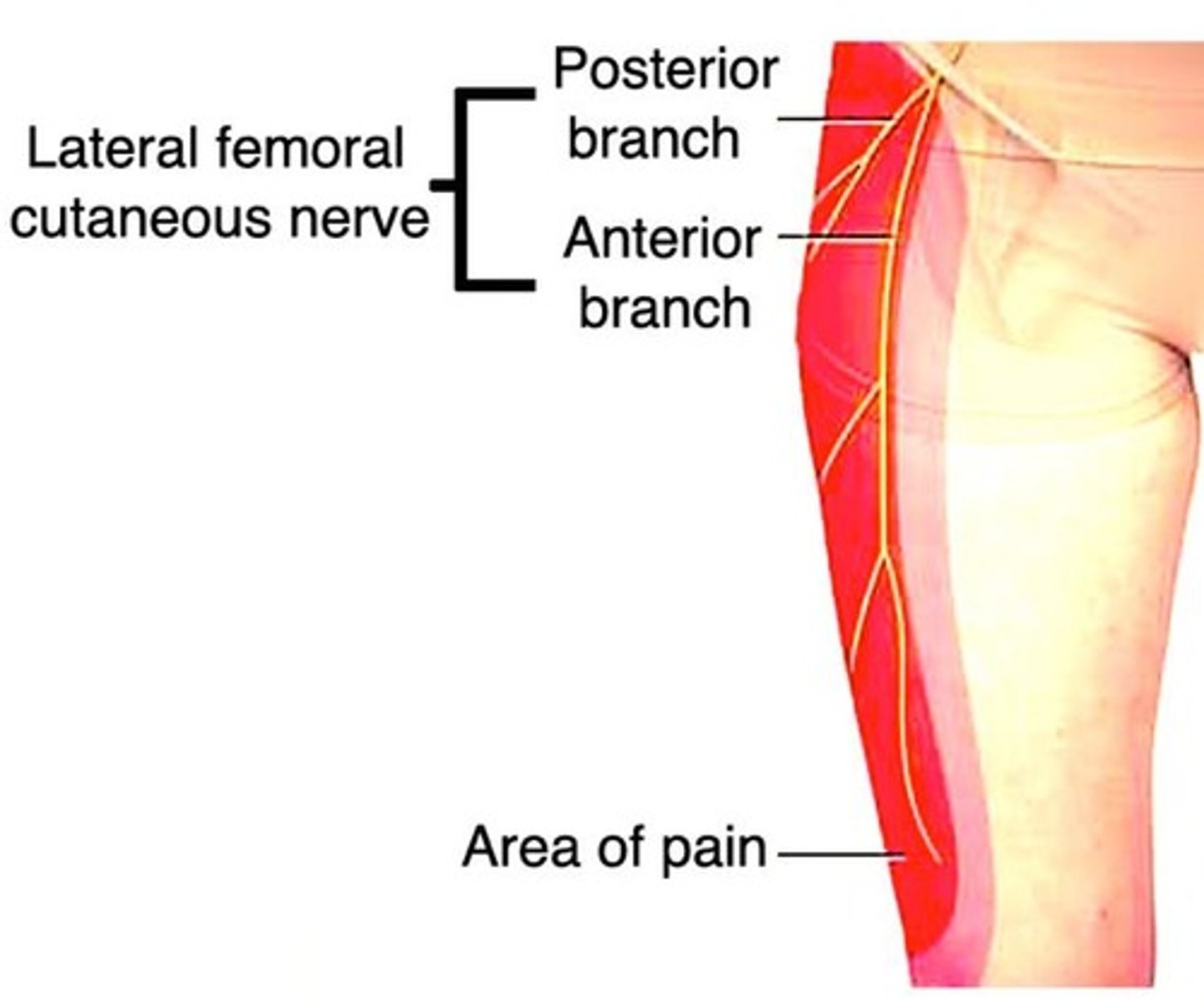<p>Middle cerebral artery stroke leads to motor/sensory abnormalities of contralateral arm + face.</p>