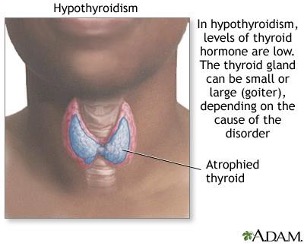 <p>Another name for hypothyroidism</p>