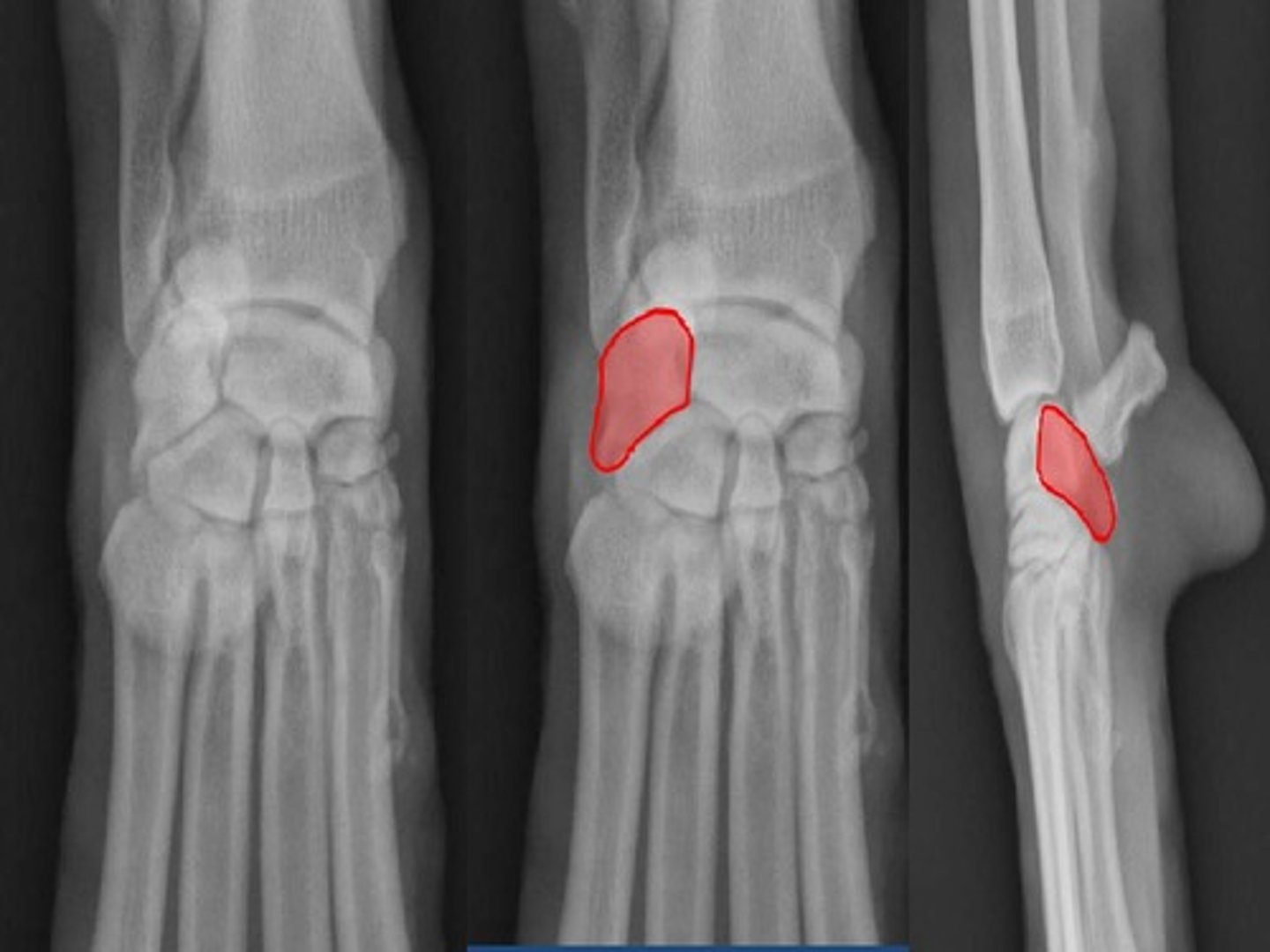 <p>the lateral carpal bone of the proximal row</p>