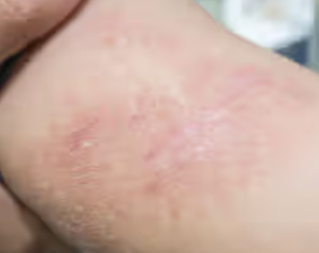 <p>Secondary Skin Lesion</p>