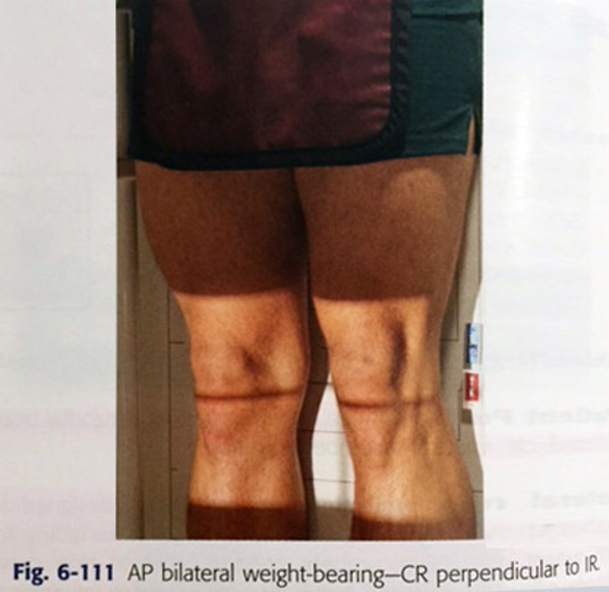 <p>1. Patient stands with the posterior aspect of the knee joint in contact with the upright bucky (no grid required).</p><p>2. Patient's weight should be evenly distributed.</p><p>3. The lower leg is rotated until the patella is centralised and the femoral condyles equidistant to the IR.</p><p>4. Make sure that the patient's leg is fully extended and that they are standing up straight against the bucky.</p>