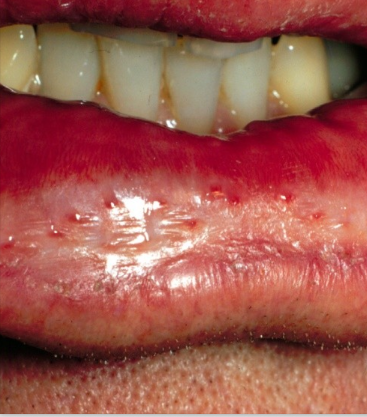 <p>What is the cause of cheilitis glandularis? Where might you find it?</p>