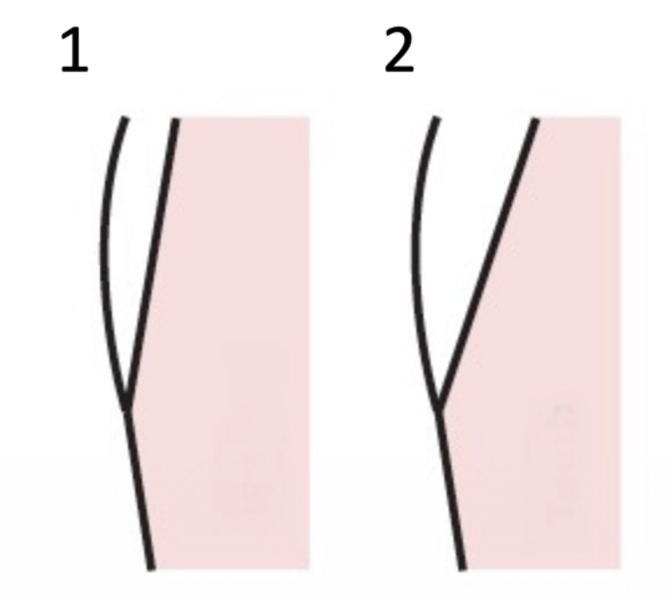 <p>What type of margin design is at 1?</p>