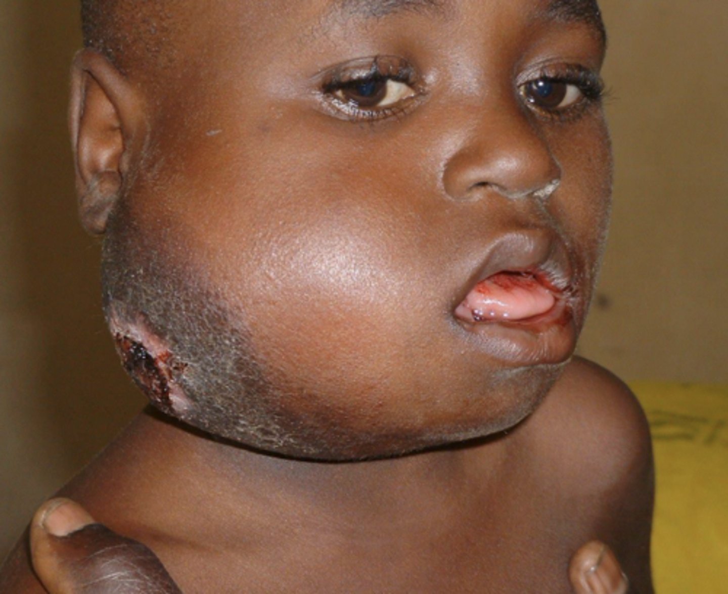 <p>= fastest growing tumor in existence</p><p>- in Eastern Africa</p><p>- affects mandible or maxilla</p><p>- May affect vision, very fast growing</p><p>- Treated with chemotherapy</p>