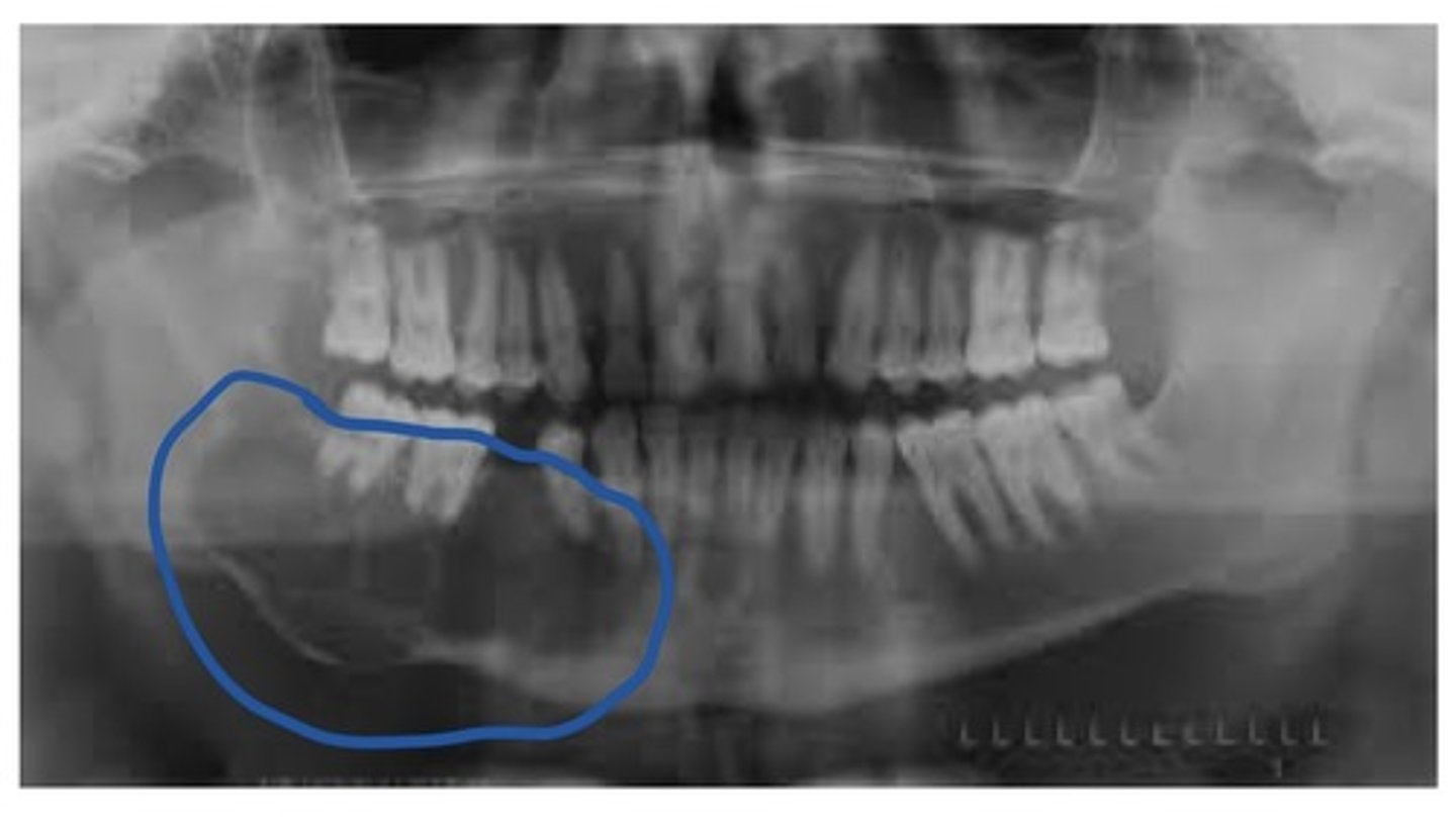 <p>This type of cyst is most often seen in the mand 3rd molar region. Can move teeth and cause resorption. Tx: high recurrence rate so, surgical removal with osseous curettage is recommended. Radiographic: frequently appears as a well defined, multilocular, radiolucent lesion.</p>