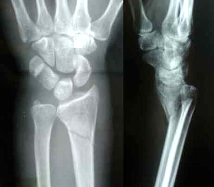 <p>fx of distal radius and ulnar styloid but  distal fragment is angulated towards volar surface</p>