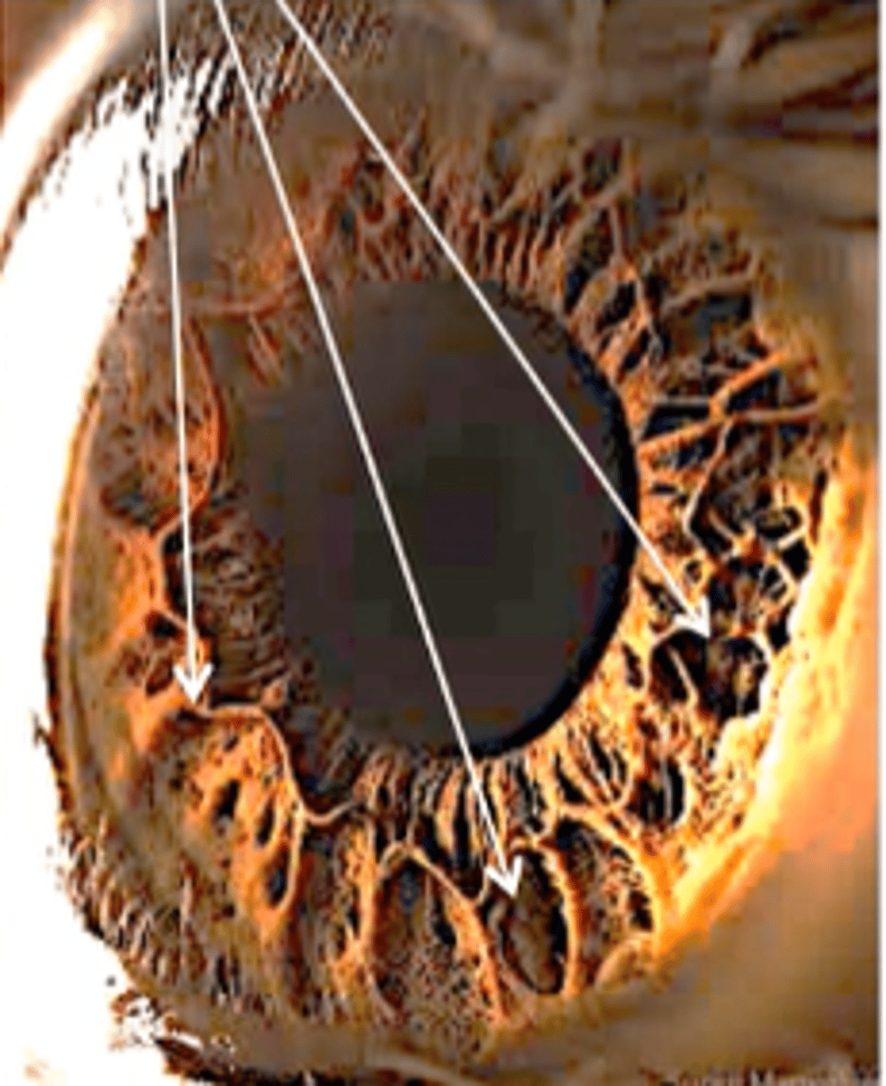 <p>allow aqueous to enter stroma, serve as "iris fingerprint"</p>