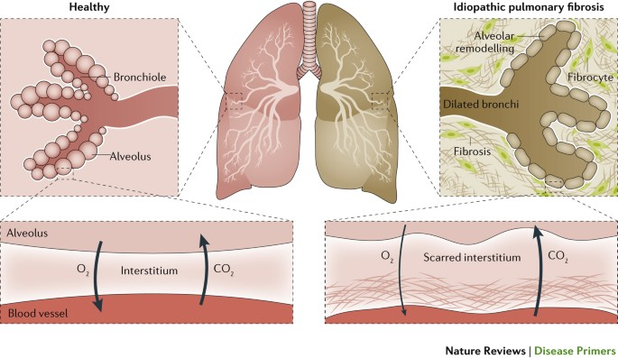 <p><strong><mark data-color="yellow" style="background-color: yellow; color: inherit;">the most common idiopathic (unknown cause) lung disorder,</mark></strong> involving chronic inflammation and fibro-proliferation of the interstitial lung tissue. </p>
