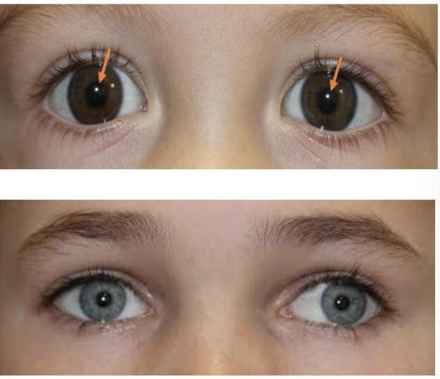 <p>A test that evaluates eye alignment and is performed by observing the reflection of light on the corneas of the eyes. </p>