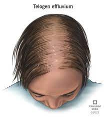 <p>a reversible condition in which hair falls out after a stressful situation.</p>