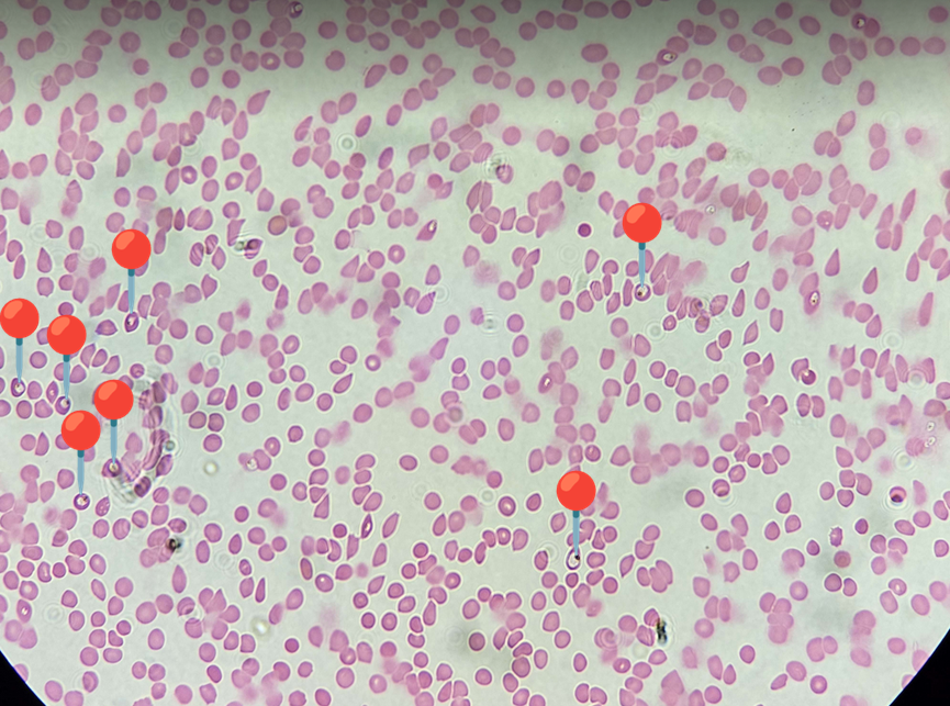 <p><span data-name="drop_of_blood" data-type="emoji">🩸</span><span data-name="microbe" data-type="emoji">🦠</span><span><span> </span></span><strong><em>Plasmodium falciparum </em></strong><sub>(Postać pierścienia)</sub></p><p></p><p></p><p><span>🔴 - postać pierścienia.</span></p><p></p><p></p><p><span>😷❓ </span><strong>Parazytoza:</strong><em> Malaria</em></p>