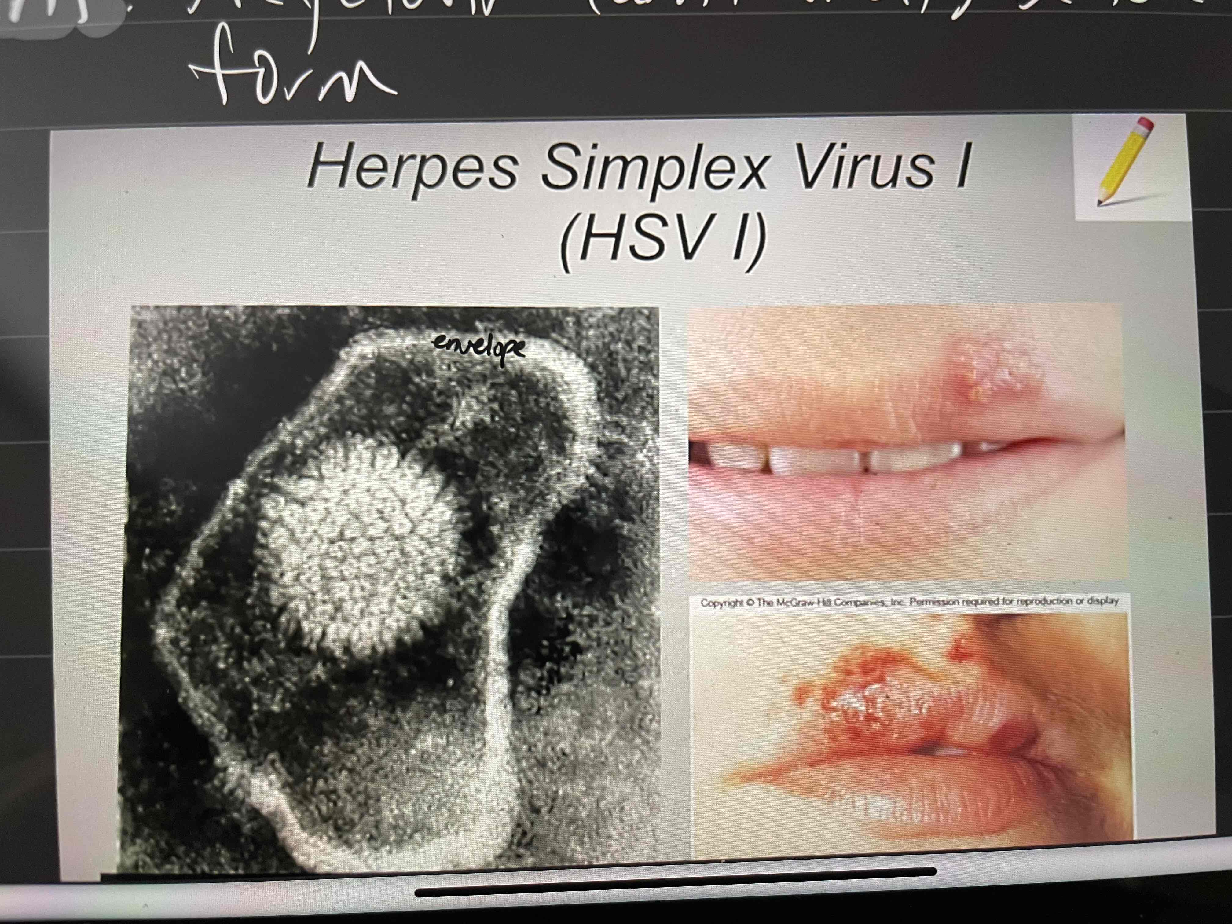 <p><strong>Type:</strong> DNA Virus, enveloped</p><p><strong>Disease:</strong> cold sores - ulcerative lesions on gum and lips (herpes)</p><p><strong>Pathogenesis:</strong></p><ul><li><p>Virus enters through oral contact w/infected host</p></li><li><p>Replicates in epithelial cells → vesicles</p></li><li><p>Virus ascends sensory neuron to posterior root ganglion</p></li><li><p>Remains dormant until future outbreak</p></li></ul><p><strong>Treatment:</strong> Acyclovir (anti-viral) before vesicles form</p><p></p>