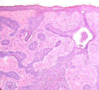 <p>Which one: <strong>Basal Cell Carcinoma</strong> OR <strong>Normal Epithelium</strong></p>