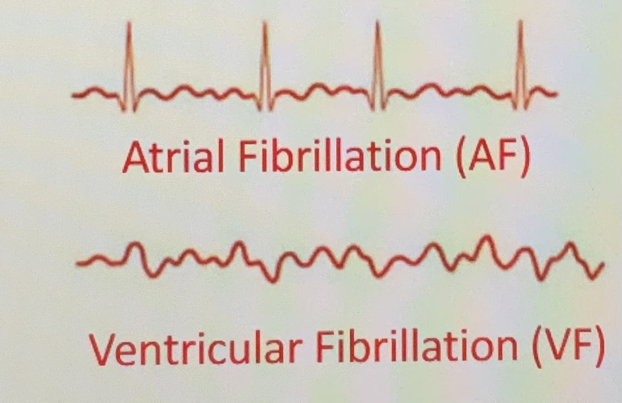 <ul><li><p>Bradychardia - slow heart rhythm</p></li><li><p>Tachycardia - fast heart rhythm</p></li><li><p>Heart block - interruption in the normal conduction pathway</p><ul><li><p>First-degree AV block</p><ul><li><p>Delay in conduction between SA and AV nodes</p></li></ul></li><li><p>Second-degree</p><ul><li><p>Only some impulses from SA node reach AV node (only P wave present occasionally)</p></li></ul></li><li><p>Third-degree</p><ul><li><p>No correlation between atrial and ventricular activity (P waves and QRS complex)</p></li></ul></li></ul></li><li><p>Fibrillation- rapid, irregular out-of-phase contractions; useless for pumping blood</p></li></ul><p></p><p></p>