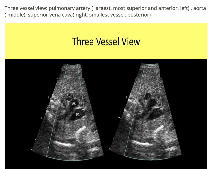 <p>a) inferior vena cava</p>