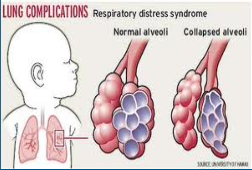 * Oily substance 
  * Produced by granular pneumocytes within alveoli
* Decreases surface tension (so lungs don’t stick together too much), allowing alveoli to be inflated
* Premature babies may lack surfactant
  * Often intubated and their lungs are sprayed with surfactant 