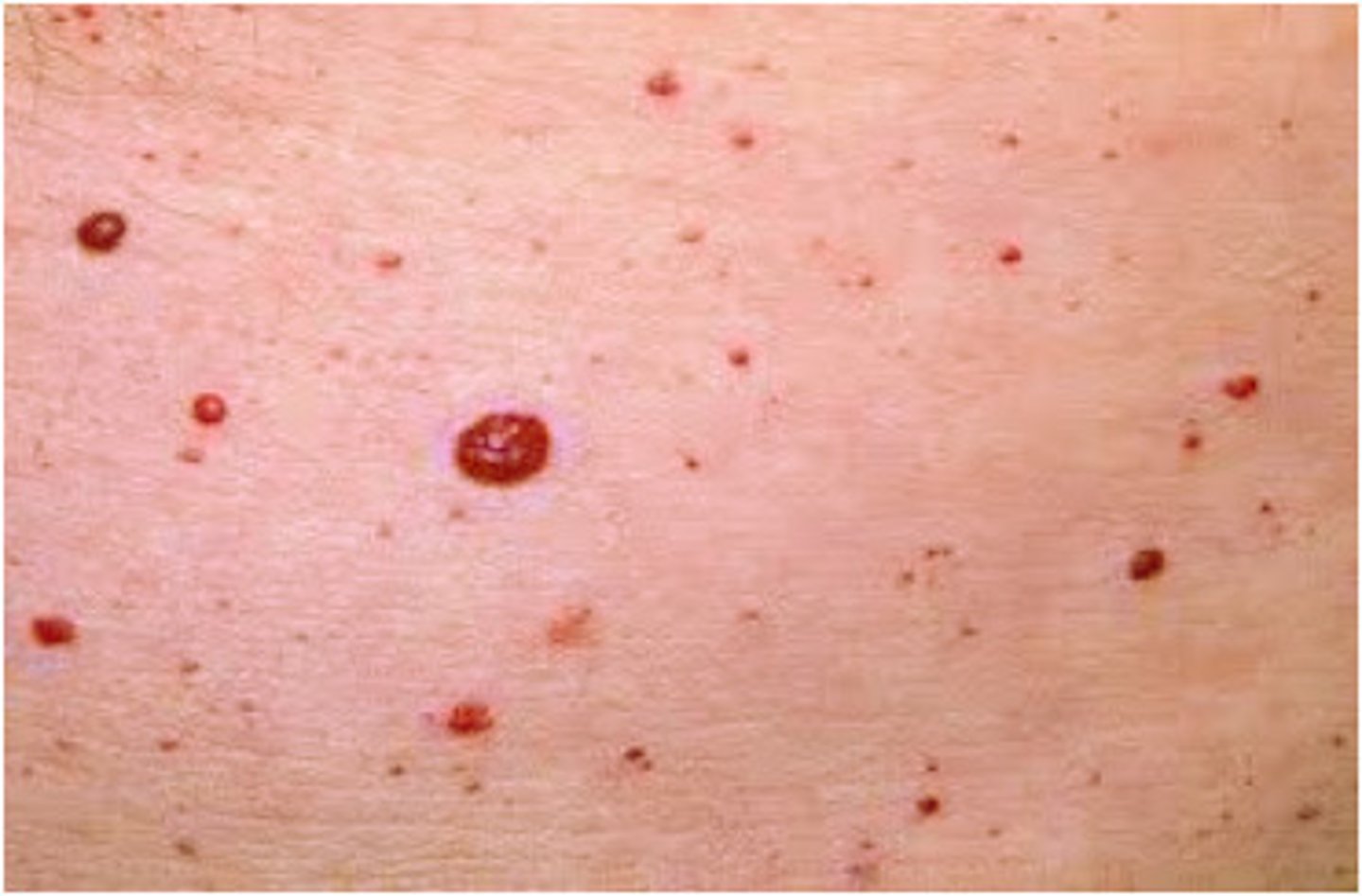 <p>-most common type of <strong>acquired benign vascular proliferation and area composed of thin-walled, dilated capillaries</strong></p><p>-often present in early to mid-adulthood and appear as small red or violaceous macules or papules that increase in number and incidence with age</p><p>-benign and thus do not require treatment unless irritated or bleeding, but are often of cosmetic concern</p>