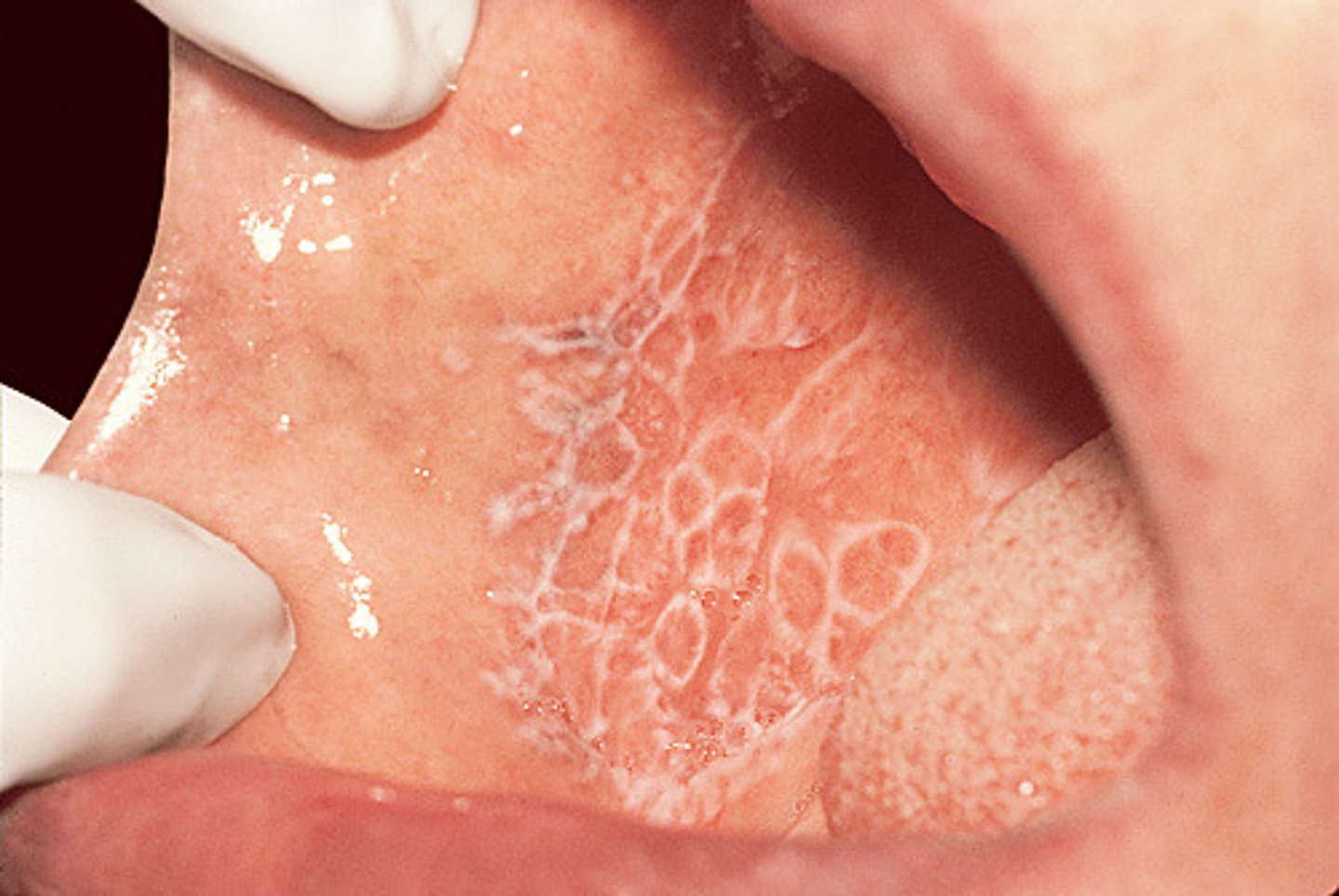 <p>Mucosal Lichen Planus</p>