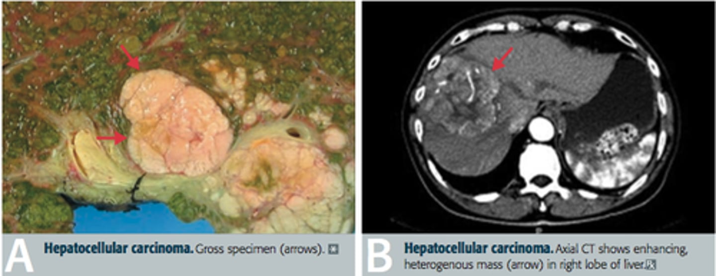 <p>- Malaise</p><p>- Weight loss</p><p>- Anorexia</p><p>- Abdominal discomfort</p>