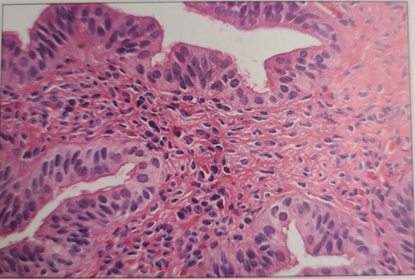 <p>c. smudgy nuclei</p><p>- The nuclear problem seen in this image is smudgy nuclei, or the lack of a visible chromatin pattern, especially in the epithelium.</p>