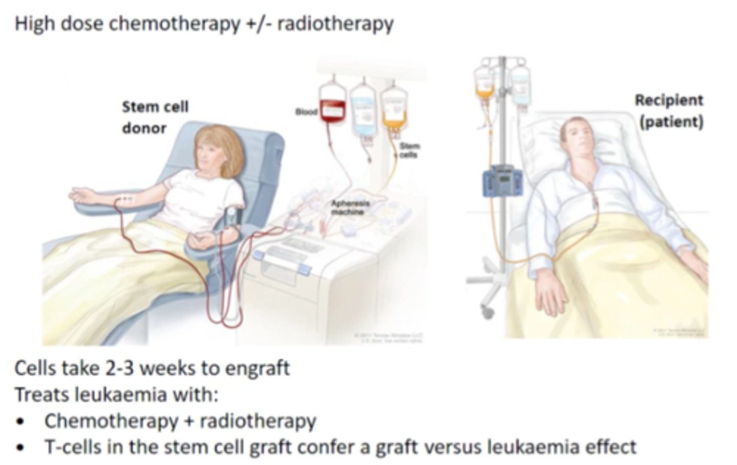<p>the stem cells used for transplantation are from a donor</p><p>- serious risks and AEs (graft vs. host disease)</p><p>- preferred for young and healthy patients</p>
