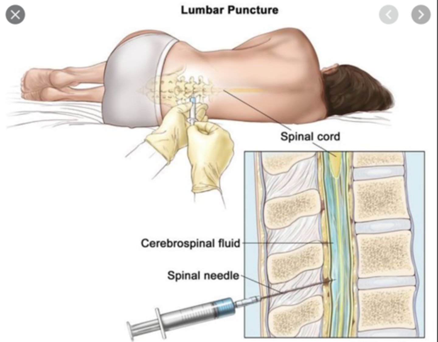<p>Drug delivered directly into CSF bypassing the blood-brain barrier.</p>
