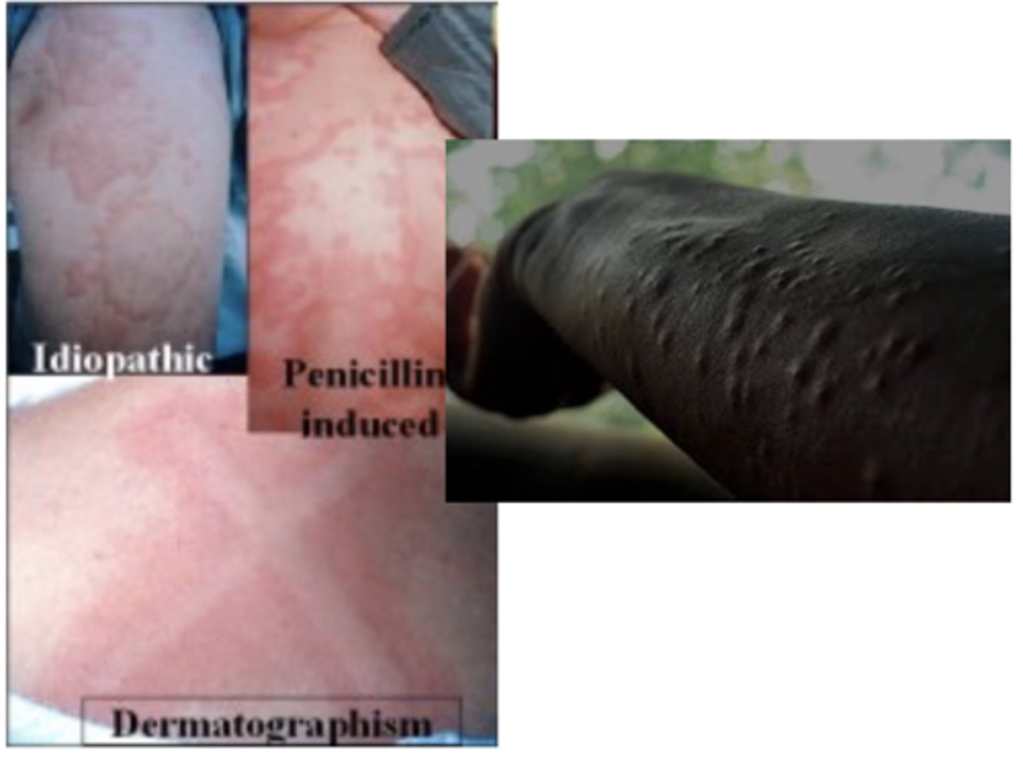 <p>Drugs that inhibit the H1 receptor block the triple response.</p>