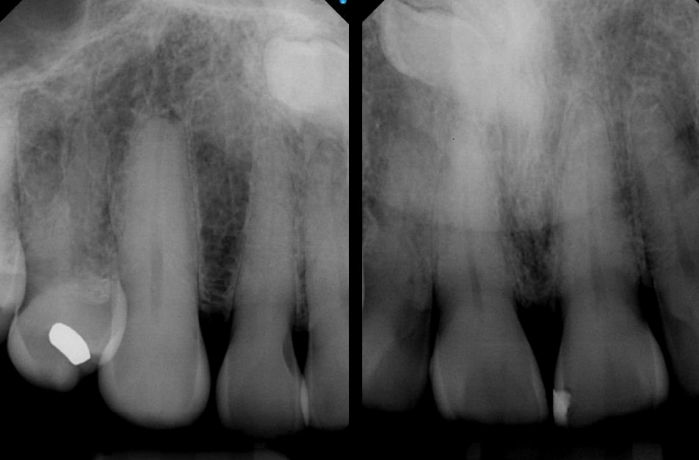 <p>is the crown of the supernumerary tooth facial or palatal to the apex </p>