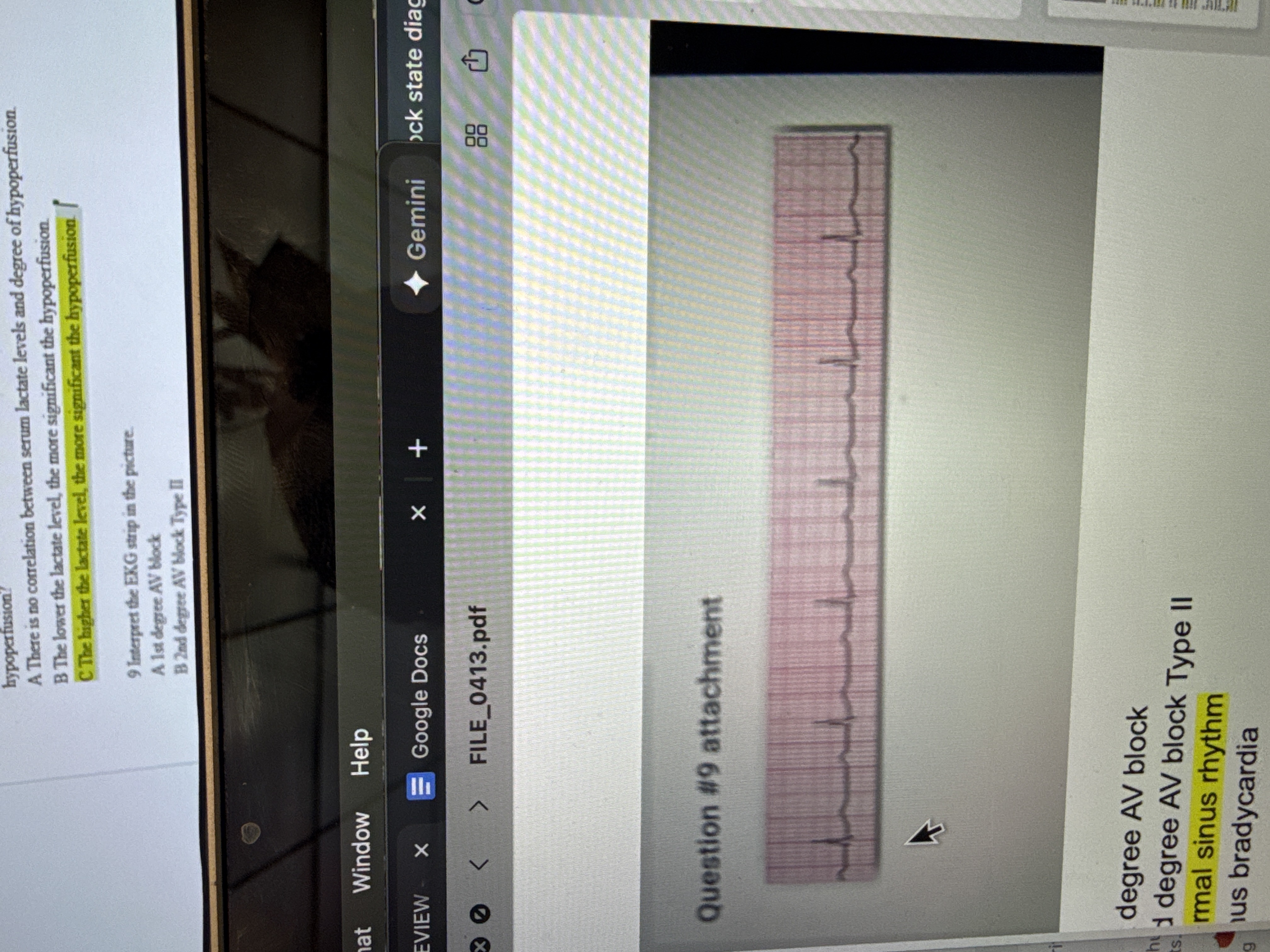 <p><span style="background-color: transparent; font-family: "Times New Roman", serif;"><span>Interpret the EKG strip in the picture.</span></span></p><p><span style="background-color: transparent; font-family: "Times New Roman", serif;"><span>A 1st degree AV block</span></span></p><p><span style="background-color: transparent; font-family: "Times New Roman", serif;"><span>B 2nd degree AV block Type II</span></span></p><p><span style="font-family: "Times New Roman", serif;"><span>C Normal sinus rhythm</span></span></p><p><span style="background-color: transparent; font-family: "Times New Roman", serif;"><span>D Sinus bradycardia</span></span></p>