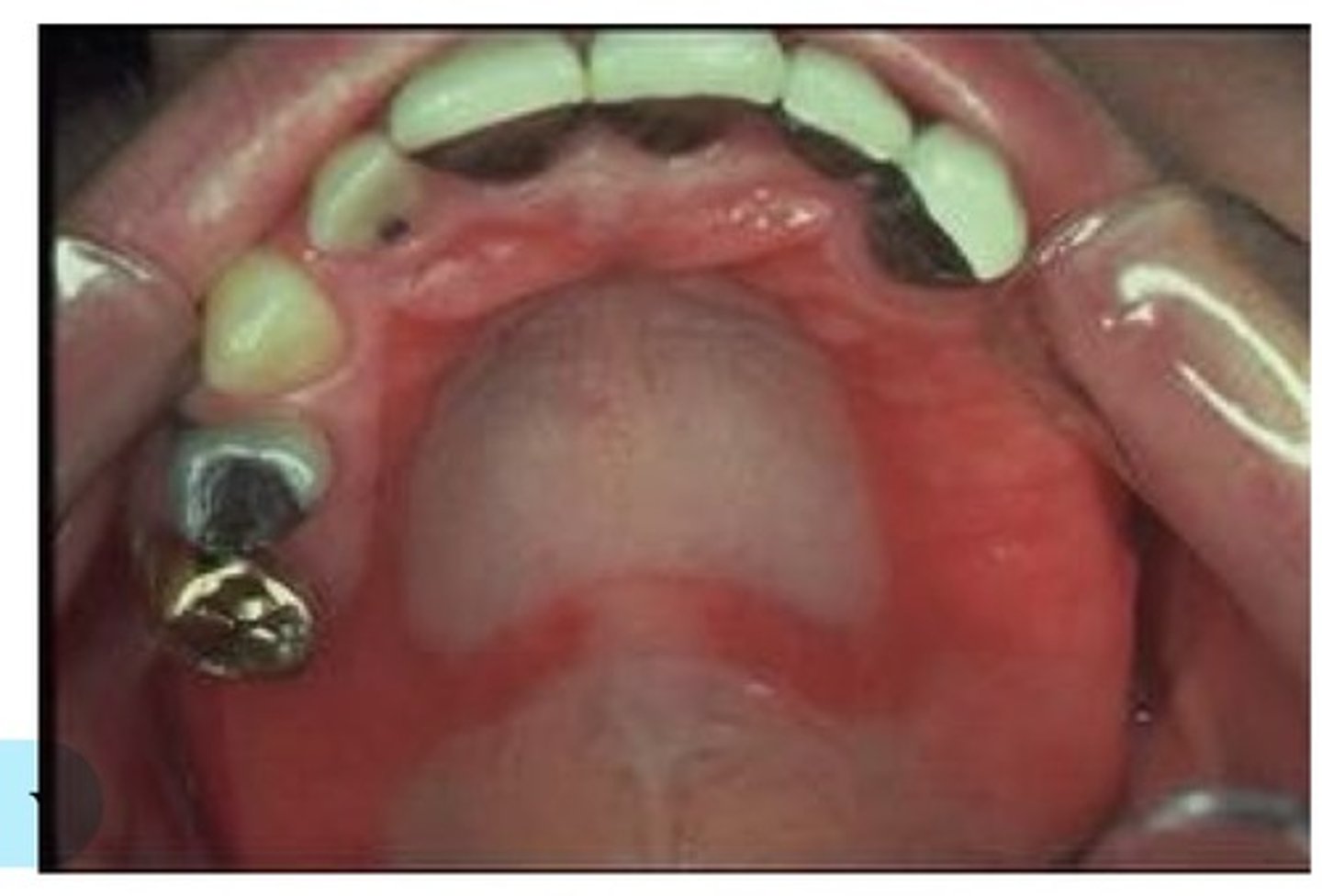 <p>This is due to ill-fitting or poor denture hygiene. May result in mucosal irritation, denture stomatitis, candidiasis, denture induced fibrous hyperplasia. This is present in as many as 65% of older individuals. Associated with poor prosthesis fit, associated with retention of denture during sleeping.</p>