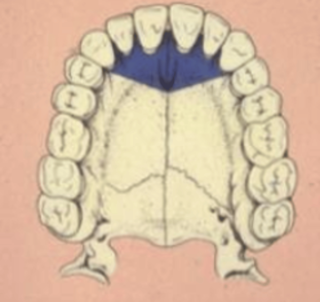 <p>Anterior portion of the hard palate anesthetized from canine to canine (6-11)</p><p>Lingual tissues only</p>