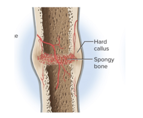 <p>Osteoblasts deposit a temporary bony collar around the fracture to unite the broken pieces while ossification (bone building) occurs</p><p></p>