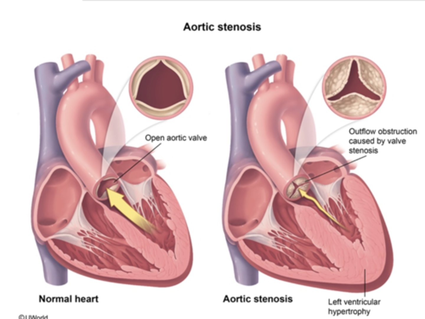 <p>valve stenosis (or malformation in which aortic valve is bicuspid) which obstructs blood from left ventricle into aorta</p>