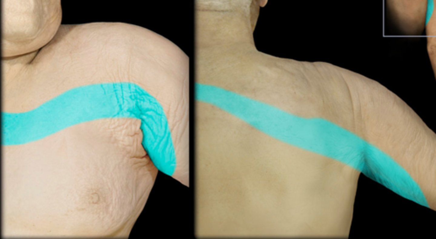 <p>Dermatome: Medial upper arm to medial elbow, pec and midscap areas</p>