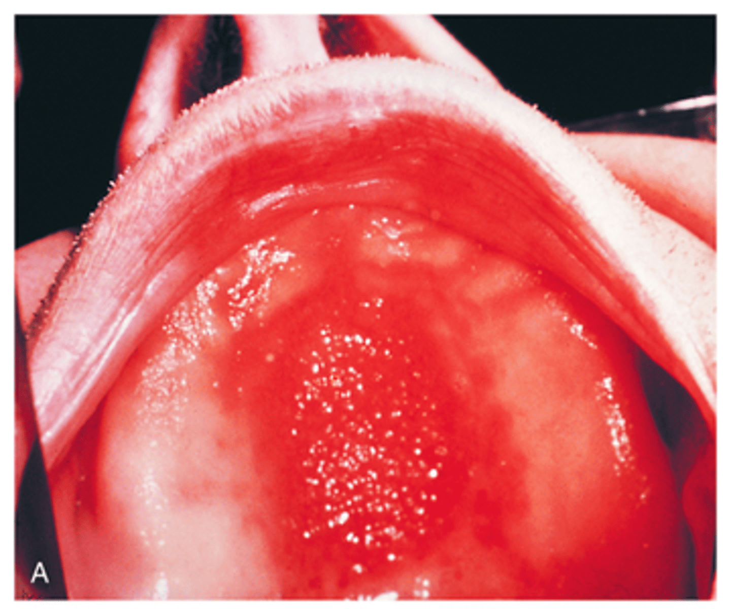 <p>Associated with ill-fitting maxillary denture/partial; Denture-induced hyperplasia; "Cobblestone" appearance</p><p><span>This granular, erythematous papillary surface of the palatal vault is called? What was it caused by?</span></p>