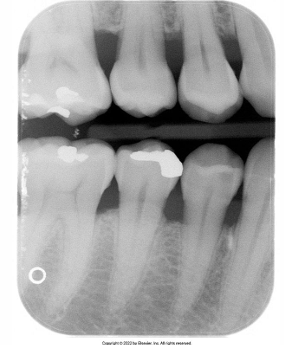 <p>How would you resolve this Debris Accumulation X-ray?</p>