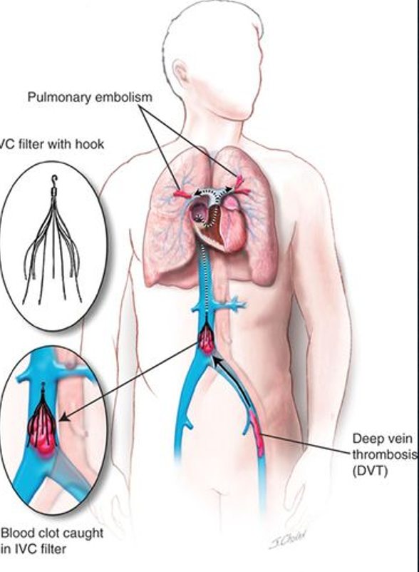 <p>catch cloths from lower leg(s) to prevent pulmonary embolism </p><ul><li><p>placed in infrarenal location </p></li></ul><p></p>