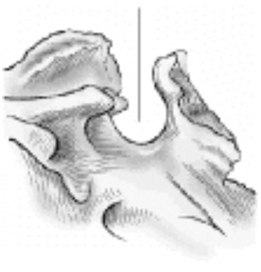 <p><strong>The part of the sphenoid bone identified by the line pointing to it in the figure below is the:</strong><br>A. Foramen magnum<br>B. Clivus<br>C. Dorsum sellae<br>D. Sella turcica</p>